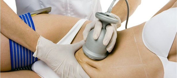 Cavitación Radiofrecuencia Vacuum Bono 10 sesiones 3 liposucción tarragona